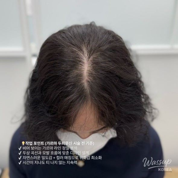 Close-up comparison of scalp density before and after micropigmentation treatment