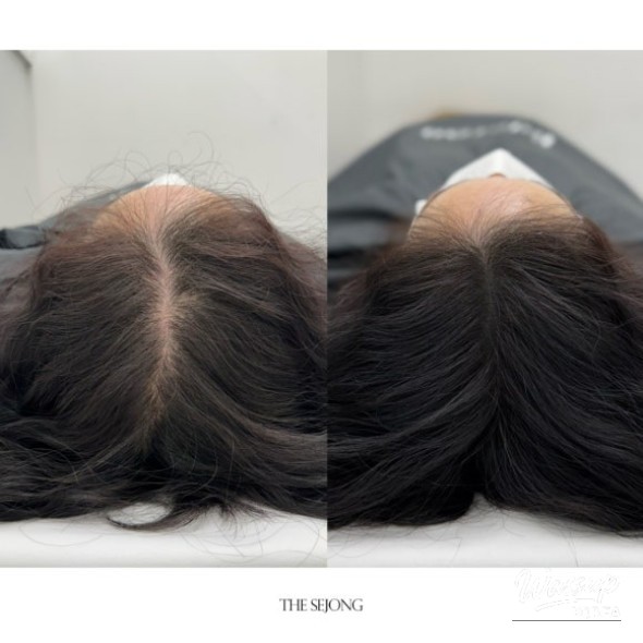 A satisfied client showing the natural-looking results after the scalp treatment