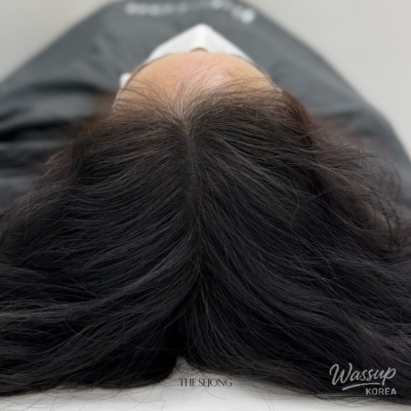 Scalp examination using professional magnifying tools to plan the procedure