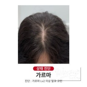 Clean and sterile equipment used for the scalp micropigmentation process