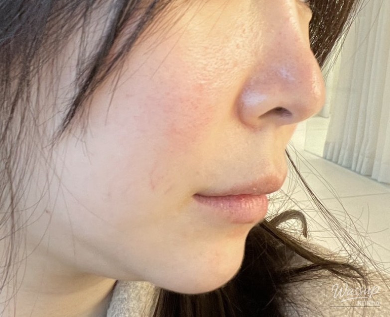 Lip filler before and after comparison